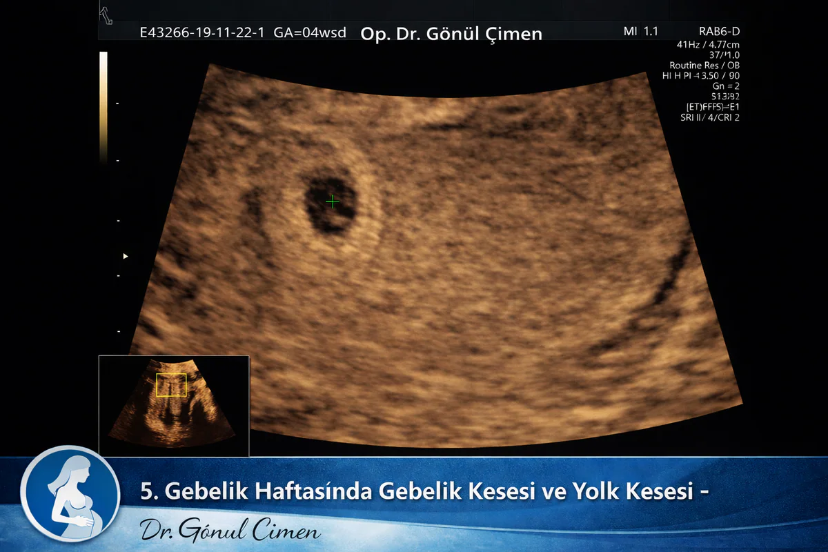 Hamileliğin ilk haftalarında gebelik kesesinin görüntüsü